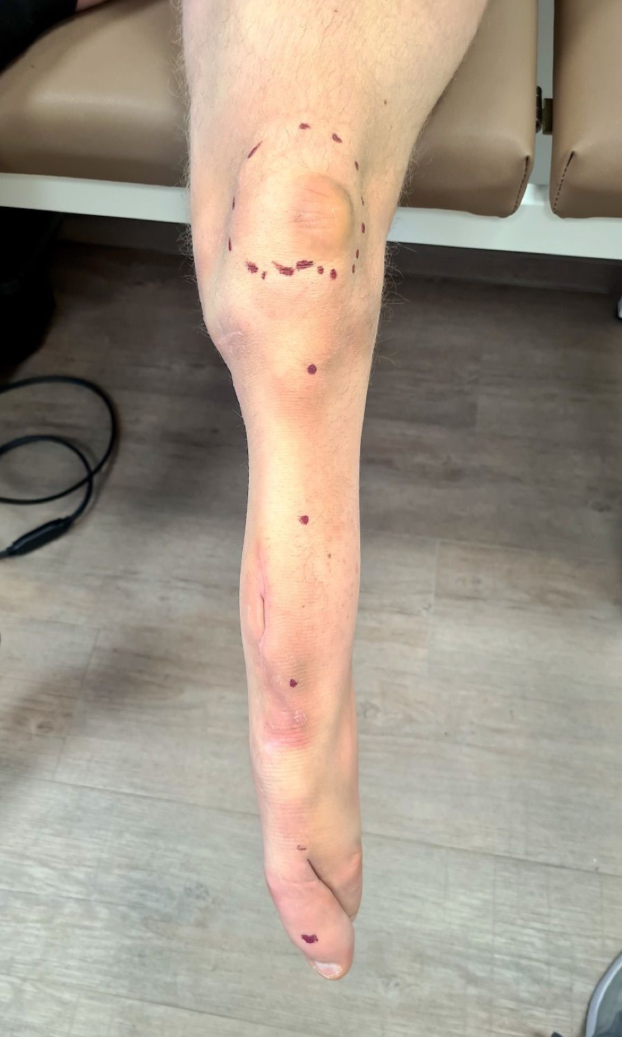 Congenital — Limb