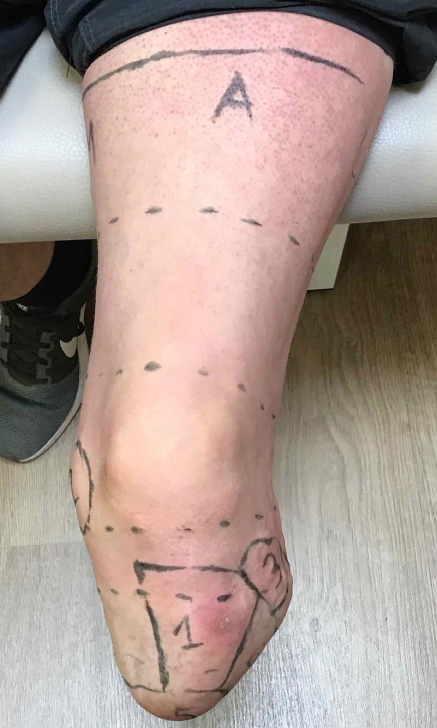 Prominente Fibula — Stumpf