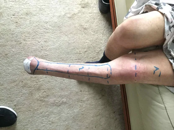 Pear Shaped residual limb
