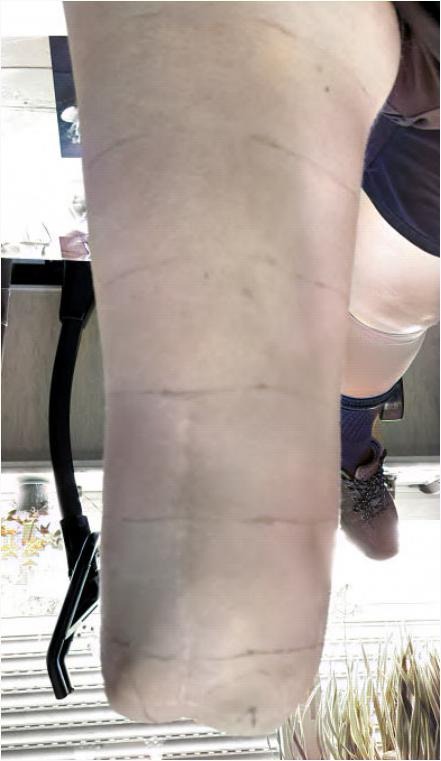 Condyles sensibles — Membre