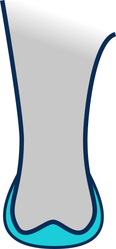 Forme distale adaptée