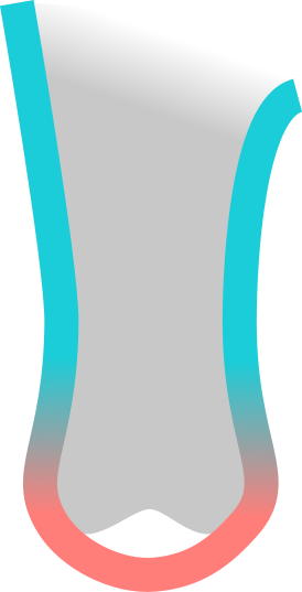 Liner standard trop étiré sur les condyles