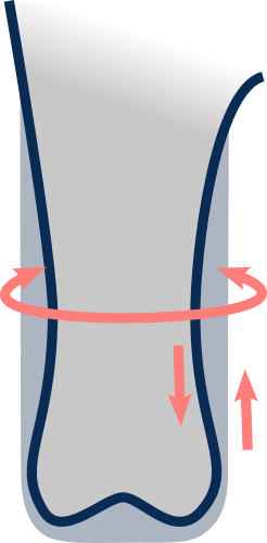 Compensation de la forme en poire