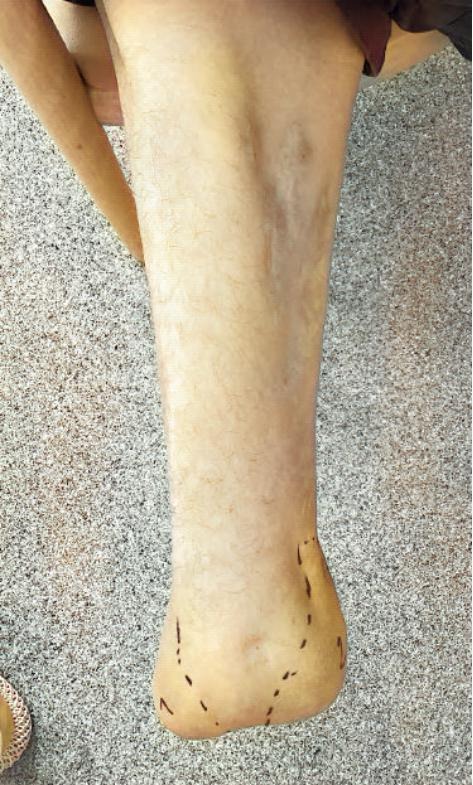 Pear Shape residual limb