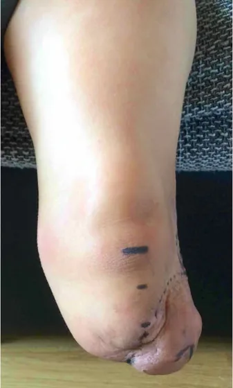 Exostosis residual limb