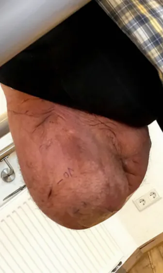 XXL residual limb