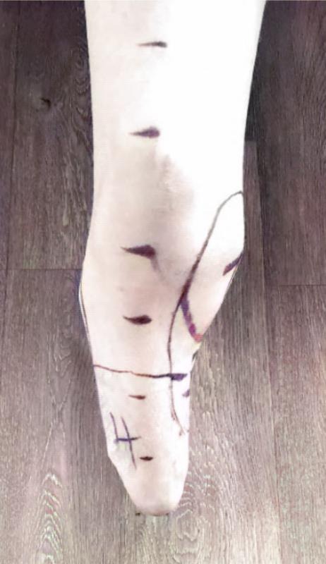 Prominent Condyle residual limb
