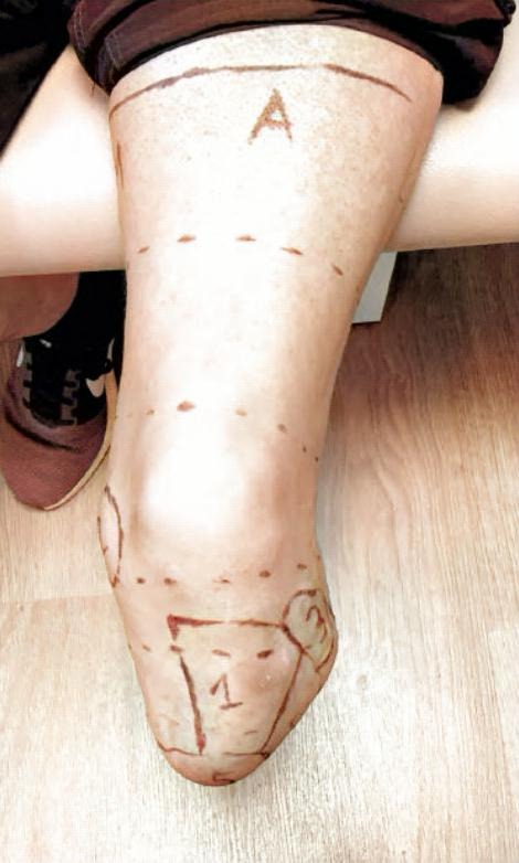 Prominent Fibula residual limb