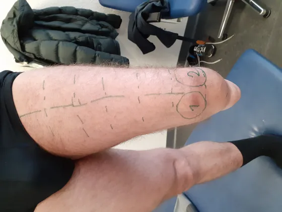 Short residual limb